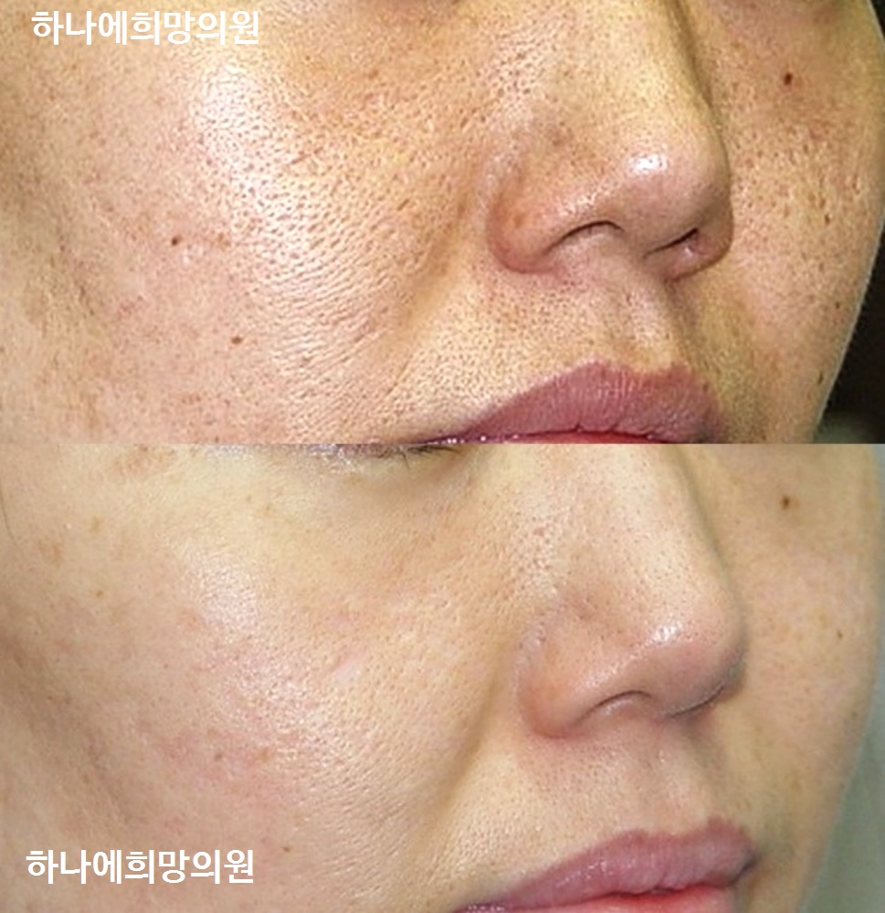 여드름흉터 Acne Scar